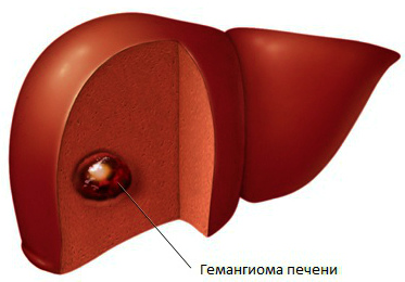 гемангиома печени