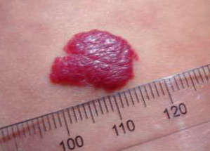 гемангиома