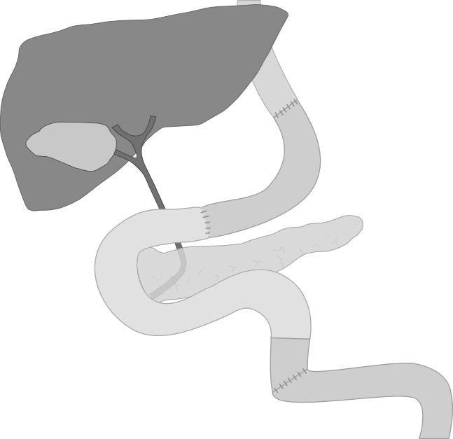 Тотальная гистерэктомия