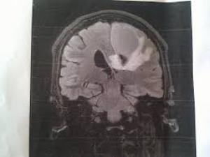 опухоль головного мозга