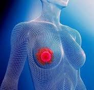 современная диагностика рака груди