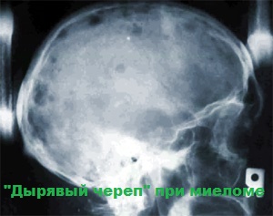 диагностика миеломы