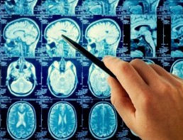 диагностика астроцитомы