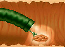биопсия при пищеводе Барретта