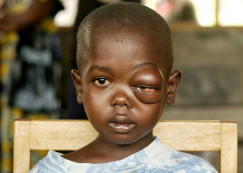 лимфома Беркитта у детей