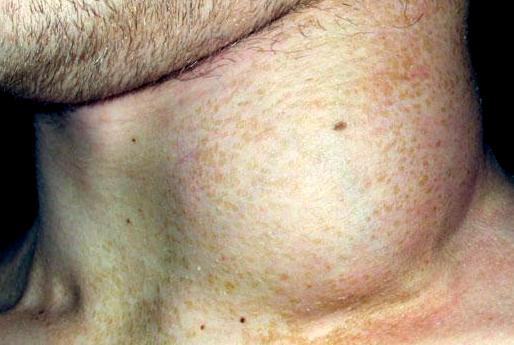 лимфома Беркитта