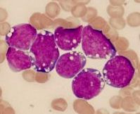 лимфома Беркитта: виды