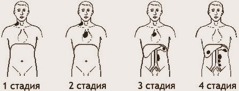 стадии лимфомы Беркитта