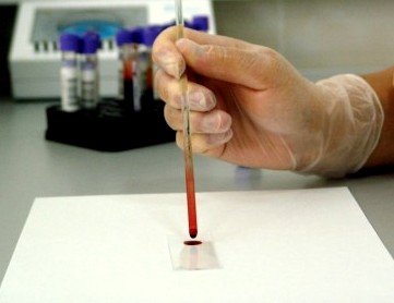 диагностика лимфомы Беркитта