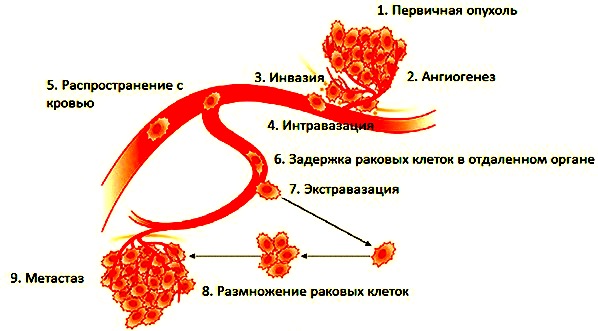 Как образуются метастазы в лимфоузлах