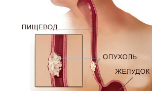 опухоли пищевода
