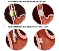 лечение опухоли пищевода