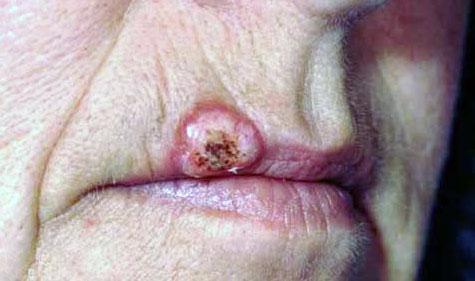 Предраковые заболевания