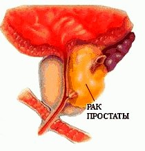 рак простаты